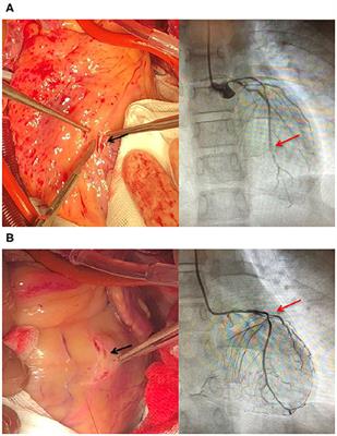 Case Report: Cardiac Surgery and Combined Lipid-Lowering Drug Therapy for Homozygous Familial Hypercholesterolemia